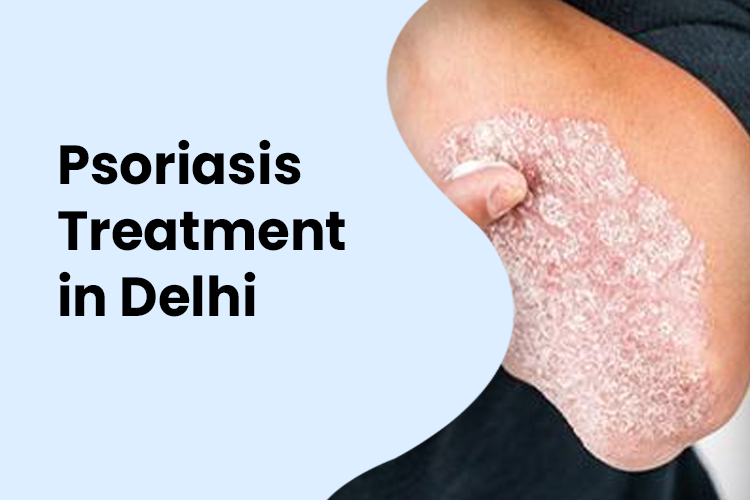 Psoriasis Treatment In Delhi | Mehektagul Dermaclinic